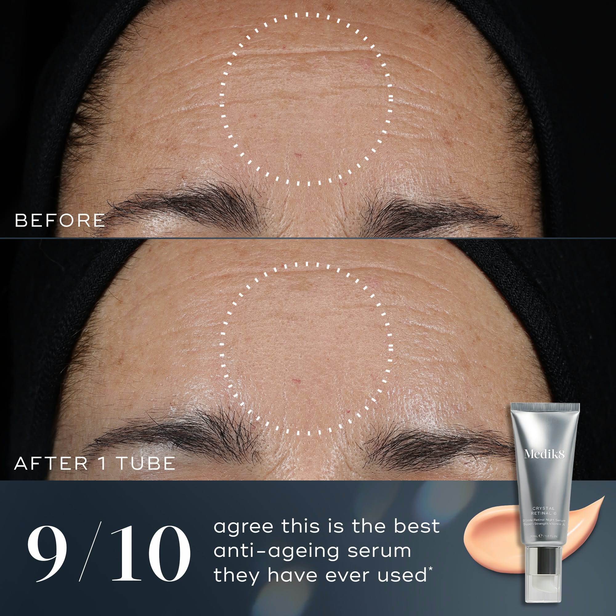 Crystal Retinal 6 Before and After 1 tube: 9/10 agree it is the best anti-ageing serum