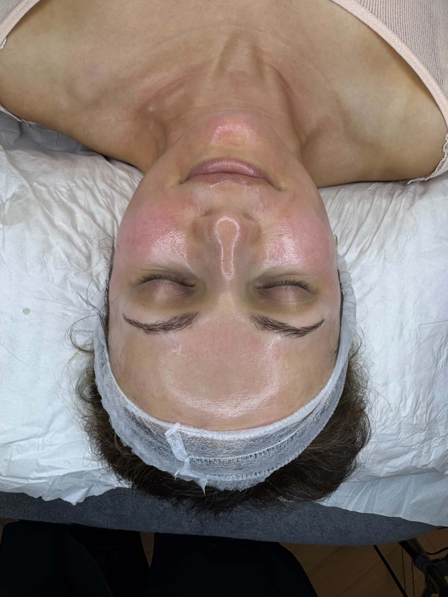 Real client skin glow immediately after Dermapen 4 and Medik8 Exo-PDRN