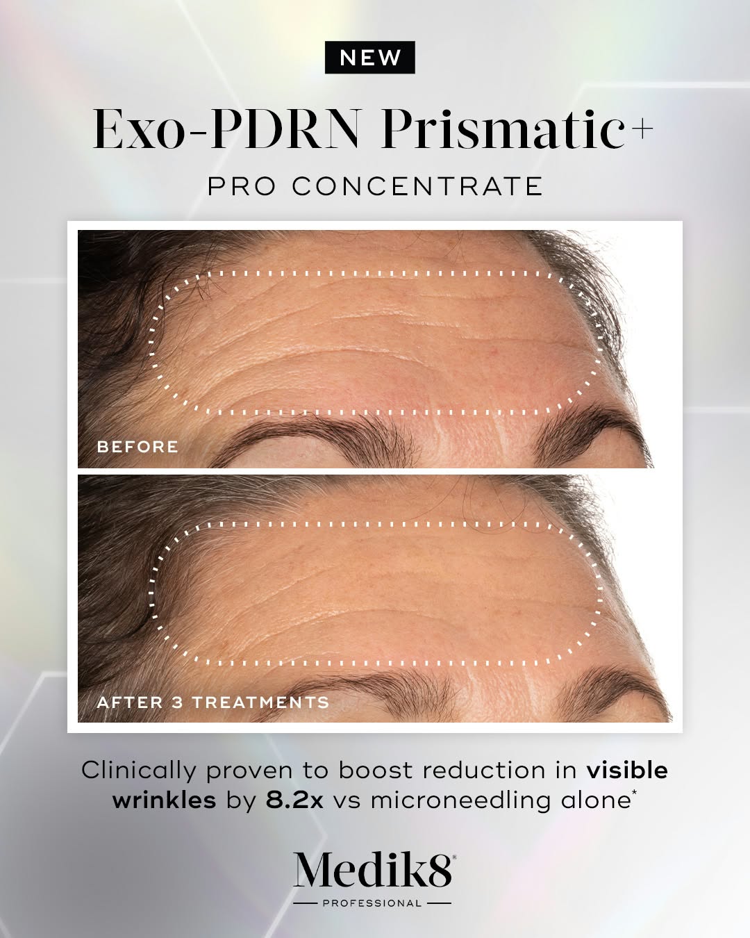 Clinical results: 8.2x visible wrinkle reduction vs microneedling alone