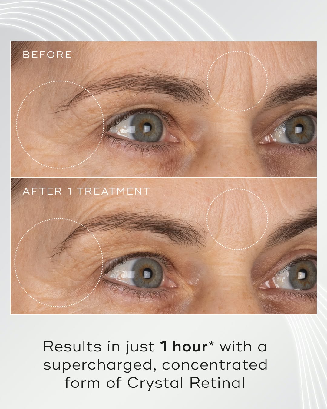 Clinical results in just 1 hour with Crystal Retinal