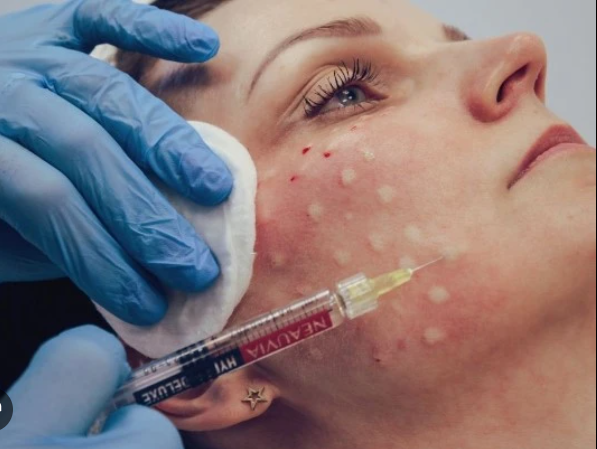 Skin booster application