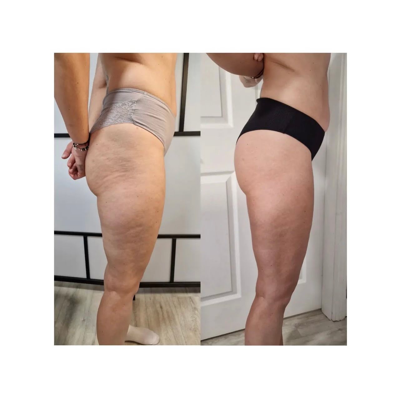 Endermologie LPG body contouring before and after result