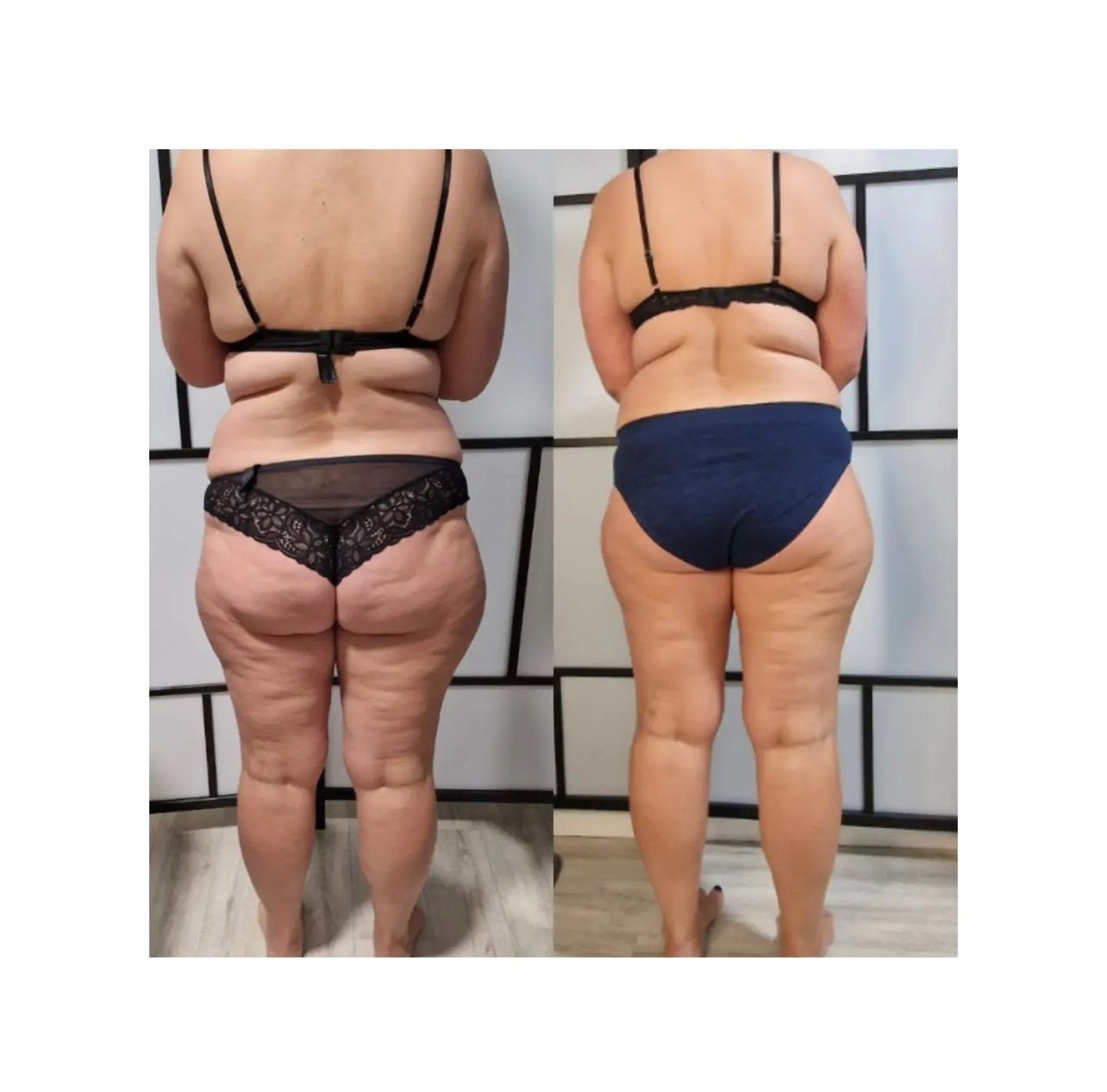 Endermologie LPG cellulite smoothing result