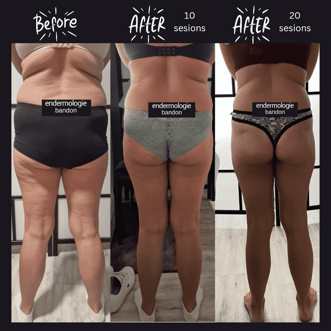 Endermologie LPG thigh and buttock smoothing result