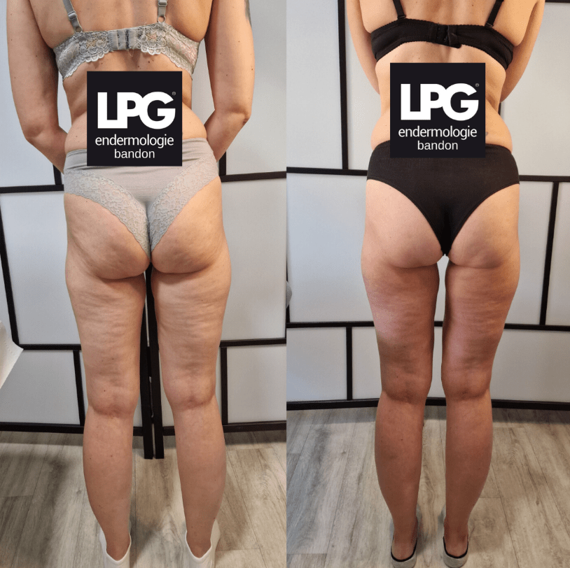 Endermologie LPG skin tightening result