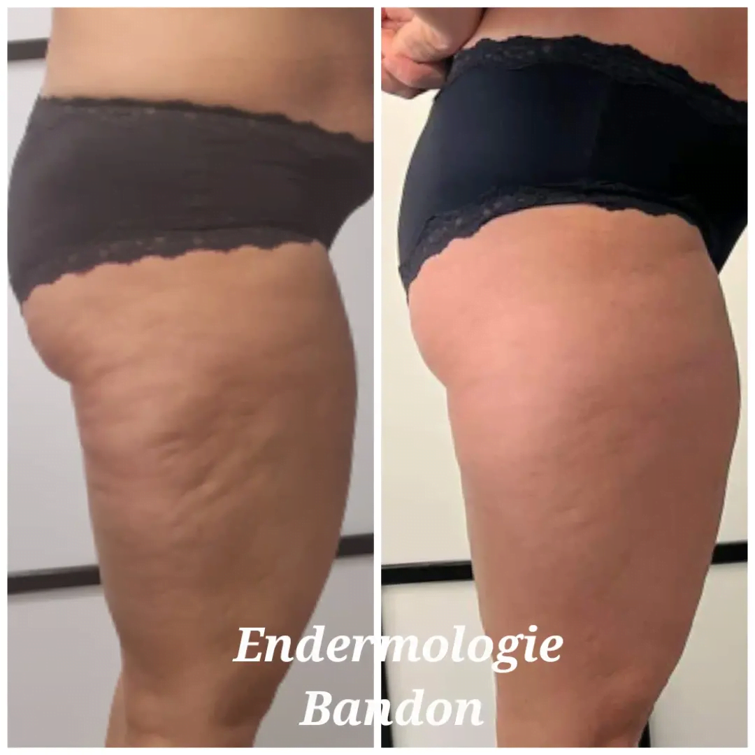 Endermologie LPG full body toning